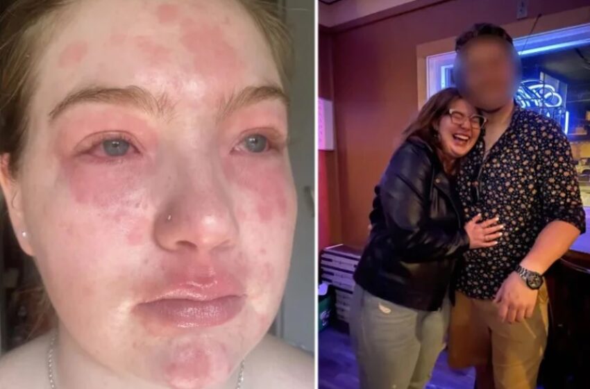  Curioso caso de mujer alérgica a su novio; la cara se le deforma